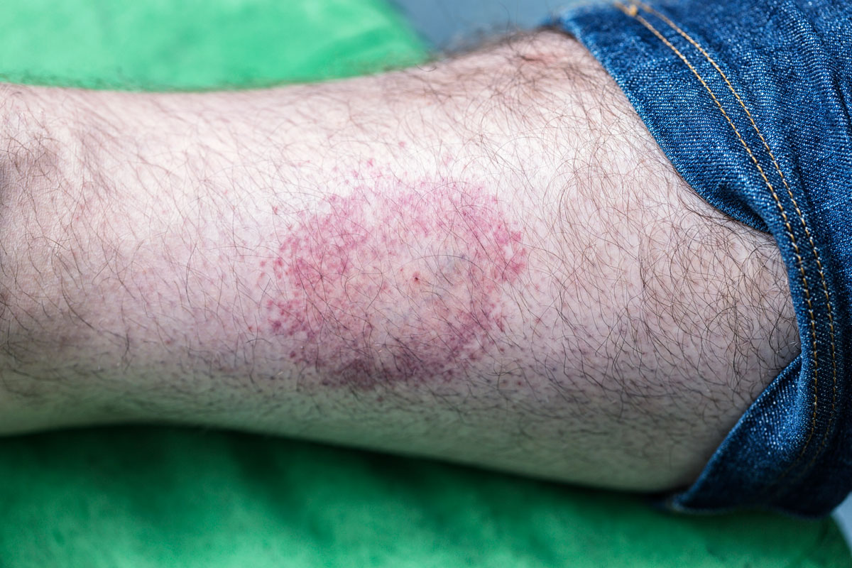 Lyme disease on the mans leg